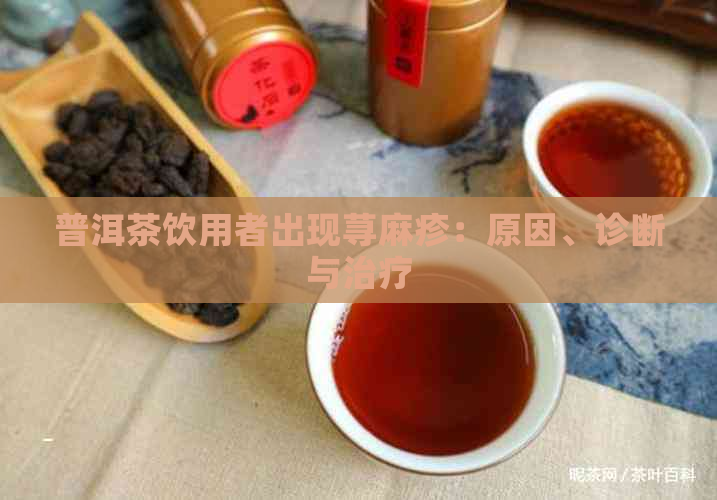 普洱茶饮用者出现荨麻疹：原因、诊断与治疗