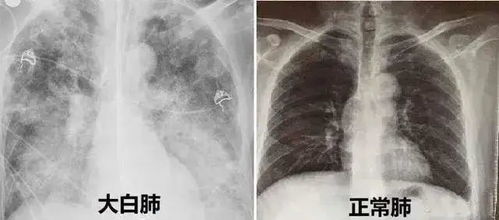 全方位解析：白燕窝与闭口的最有效解决方案及护肤策略