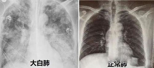 燕窝白色泡泡是什么原因呢：处理方法与治疗措施