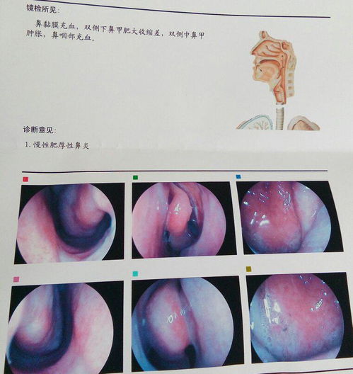 燕窝对肺气肿有什么作用吗：能吃吗、有效果吗、有帮助吗？