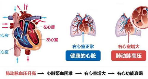 燕窝对肺气肿有帮助吗：食用燕窝对肺气肿的疗效与好处探究