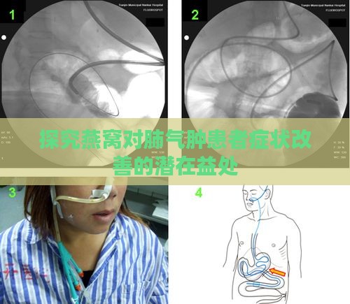 探究燕窝对肺气肿患者症状改善的潜在益处