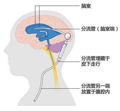 探究燕窝对肺气肿患者症状改善的潜在益处