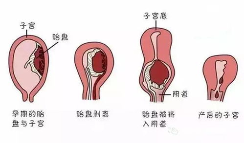 燕窝如何助力剖腹产后子宫恢复：全面解析其对产后身体恢复的作用与影响