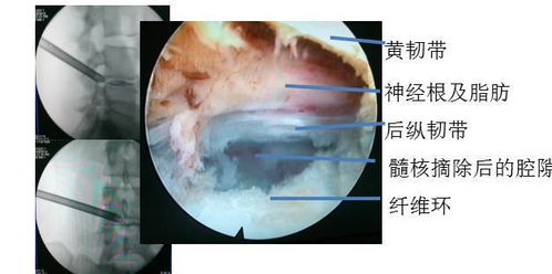 深入了解：肺结节患者能否食用燕窝及其影响解析