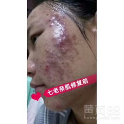 发现燕窝部位出现疼痛性疙瘩：探秘原因与应对方法