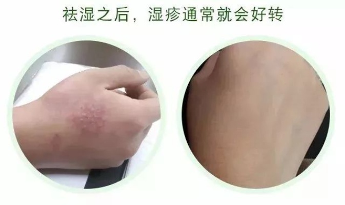 探究燕窝对于湿疹症状的缓解效果与作用机理