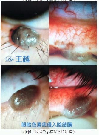 燕窝下有痣是不是不好：外观与影响探究