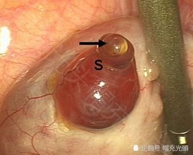 燕窝如何助力受精卵着床：全面解析其对女性生殖健康的益处