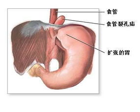 胃溃疡患者在不同康复阶段食用燕窝的更佳时间与注意事项