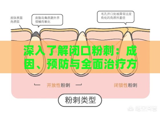 深入了解闭口粉刺：成因、预防与全面治疗方案解析