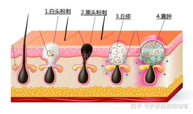 深入了解闭口粉刺：成因、预防与全面治疗方案解析