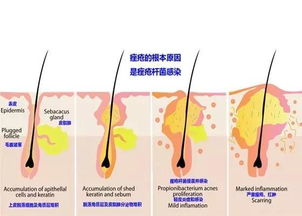 探究土燕窝对闭口粉刺的影响：是否能食用及饮食调整建议