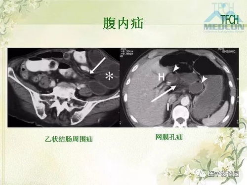 揭秘燕窝底部肿块：常见病因与症状分析及诊断方法