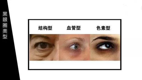 眼窝及其周围结构解析：了解眼窝、眼袋、泪沟等专业术语