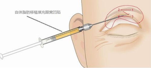 燕窝凹陷原因是什么意思