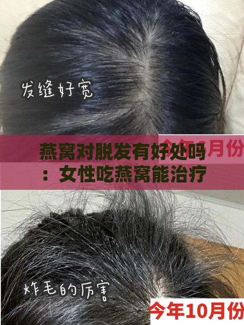 燕窝对脱发有好处吗：女性吃燕窝能治疗脱发吗？